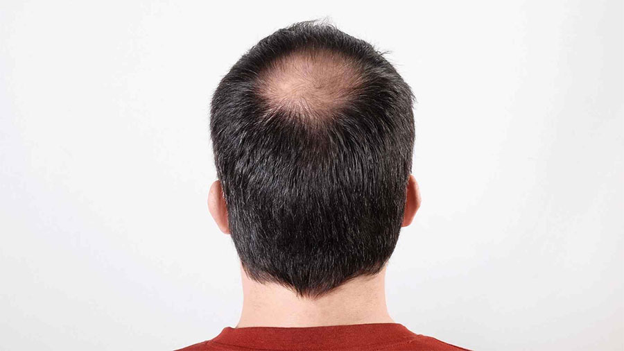 راه های جلوگیری از ریزش مو با کلاه
